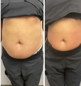 Body Shape treatment Before and After results at Petra's Weightloss Clinic Med Spa in Oklahoma City, OK