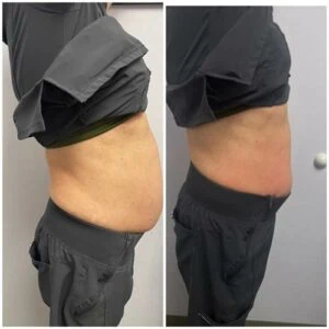 Body Shape treatment Before and After results at Petra's Weightloss Clinic Med Spa in Oklahoma City, OK
