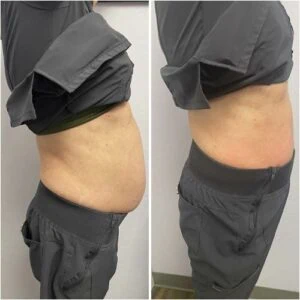 Body Shape treatment Before and After results at Petra's Weightloss Clinic Med Spa in Oklahoma City, OK