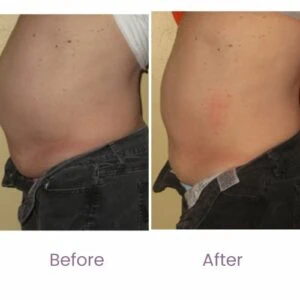 Body Shape treatment Before and After results at Petra's Weightloss Clinic Med Spa in Oklahoma City, OK