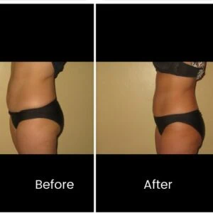 Body Shape treatment Before and After results at Petra's Weightloss Clinic Med Spa in Oklahoma City, OK