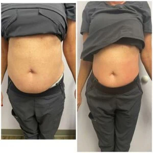 Body Shape treatment Before and After results at Petra's Weightloss Clinic Med Spa in Oklahoma City, OK