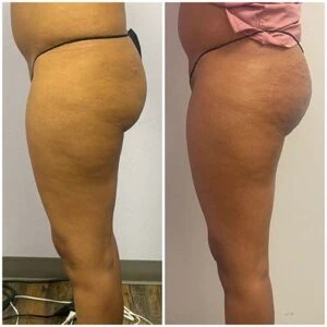Booty lift results showing fuller appearance and natural lift.