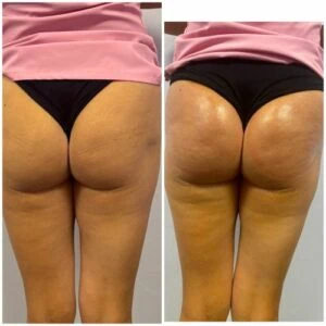 Buttocks shaping results with before and after photos after body contouring.