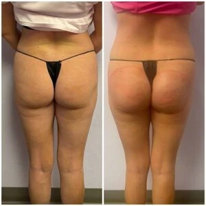 Before and after glute contouring showing enhanced shape and defined curves.