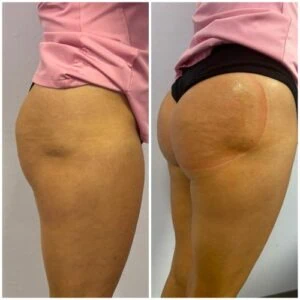 Thigh cellulite before and after cavitation therapy.