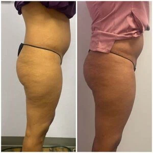Booty lift before and after comparison with smoother curves and improved tone.