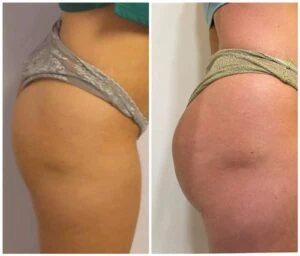 Side view of a woman’s hip and waist before and after fat loss.