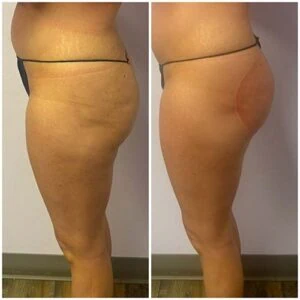 Non surgical booty lift before and after showing subtle but noticeable lift.
