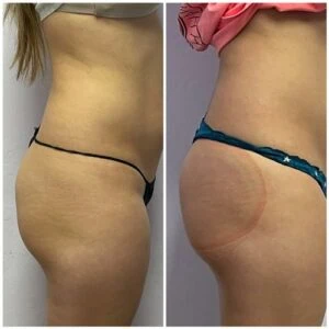 Before and after booty lift featuring enhanced symmetry and height.