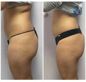 Booty lift results comparison highlighting improved volume and roundness.