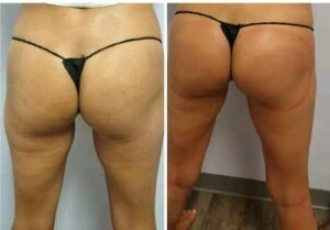 Before and after glute enhancement revealing lifted and more sculpted results.