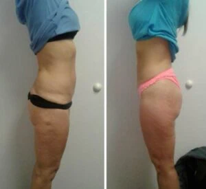 Booty lift transformation with noticeable increase in contour and firmness.