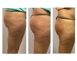 Before and after booty lift results showing improved lift and rounder shape.