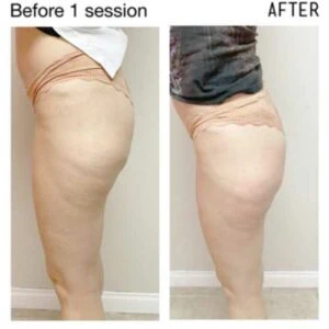 Booty lift before and after showing increased volume and natural-looking enhancement.