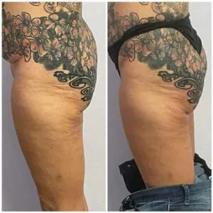 Booty lift results showing enhanced roundness and sculpted definition.