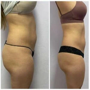 Before and after butt lift showing smoother shape and higher positioning.