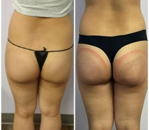 Non surgical booty lift before and after with subtle but noticeable lift.
