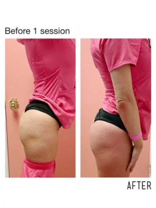 Before and after booty enhancement showing improved symmetry and lift.