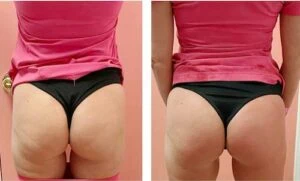 Booty lift transformation highlighting dramatic shape and volume improvement.