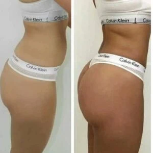 Before and after glute enhancement showing improved shape and symmetry.