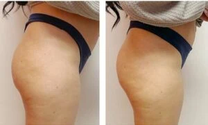 Before and after glute enhancement with visibly lifted and fuller results.
