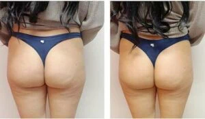 Booty lift before and after comparison showing improved contour and firmness.