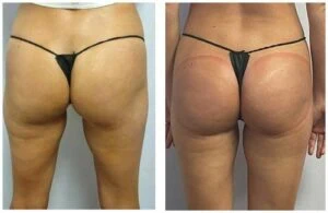 Before and after booty lift results showing enhanced lift and roundness.