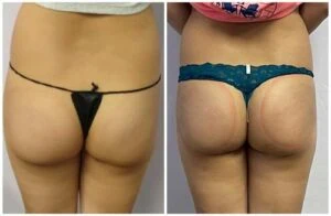Before and after non-surgical booty lift with refined contour.