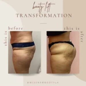 Booty lift results comparison highlighting increased volume and lift.