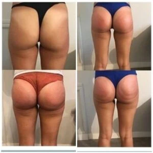 Booty lift transformation with visibly fuller and more lifted results.