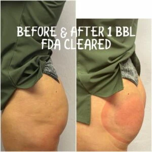 Before and After Booty Lift