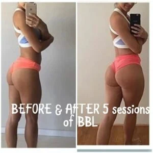 Visible butt lift before and after five session results.