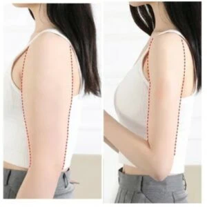 Fat Freezing Arms treatment Before and After results at Petra's Weightloss Clinic Med Spa in Oklahoma City, OK