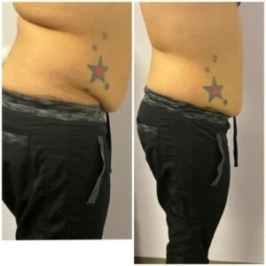 Fat Freezing treatment Before and After results at Petra's Weightloss Clinic Med Spa in Oklahoma City, OK