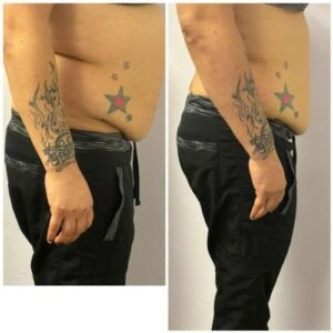 Fat Freezing treatment Before and After results at Petra's Weightloss Clinic Med Spa in Oklahoma City, OK