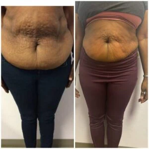 Fat Freezing treatment Before and After results at Petra's Weightloss Clinic Med Spa in Oklahoma City, OK