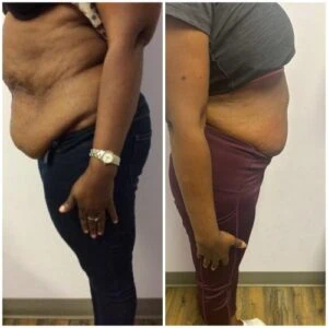 Fat Freezing treatment Before and After results at Petra's Weightloss Clinic Med Spa in Oklahoma City, OK