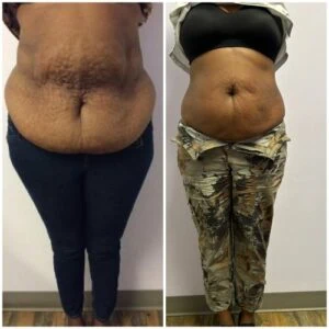 Fat Freezing treatment Before and After results at Petra's Weightloss Clinic Med Spa in Oklahoma City, OK