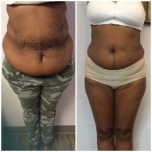 Fat Freezing treatment Before and After results at Petra's Weightloss Clinic Med Spa in Oklahoma City, OK