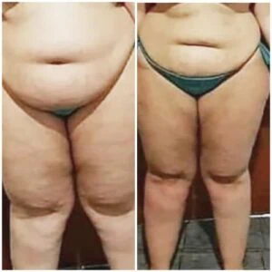 Fat Freezing treatment Before and After results at Petra's Weightloss Clinic Med Spa in Oklahoma City, OK