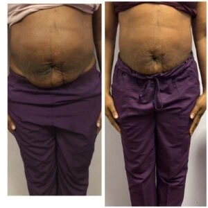 Fractional Rf Before and After results at Petra's Weightloss Clinic Med Spa in Oklahoma City, OK