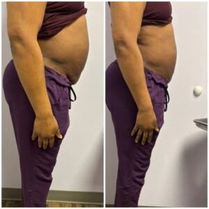 Fractional Rf Before and After results at Petra's Weightloss Clinic Med Spa in Oklahoma City, OK