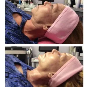 Fractional Rf Before and After results at Petra's Weightloss Clinic Med Spa in Oklahoma City, OK