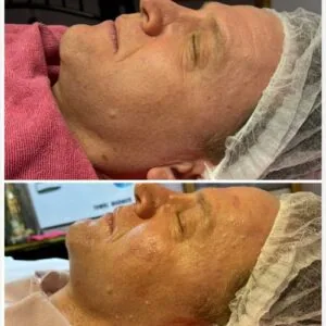 man Before and After HIFU A