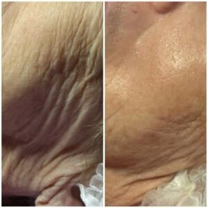 woman Before and After HIFU A
