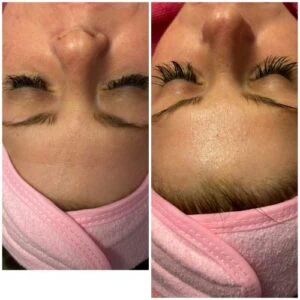 woman Before and After HIFU B