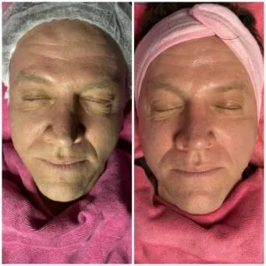 man Before and After HIFU B