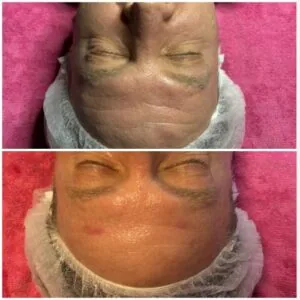 man Before and After HIFU C