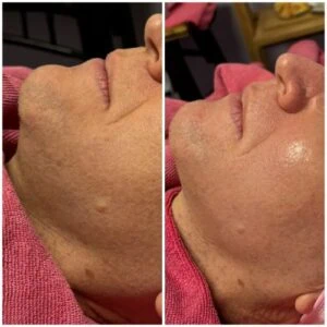 man Before and After HIFU C